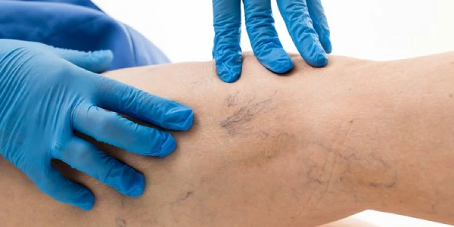 Как бороться с варикозом