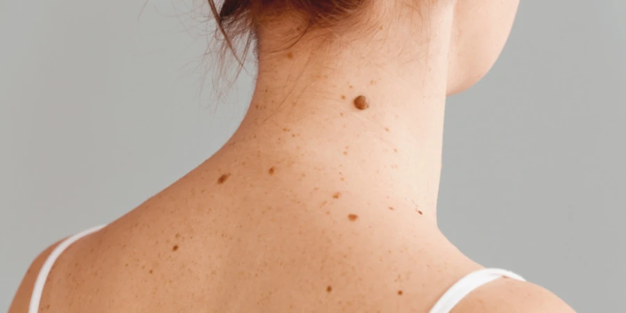 Родинки могут перерасти в рак: миф или правда?