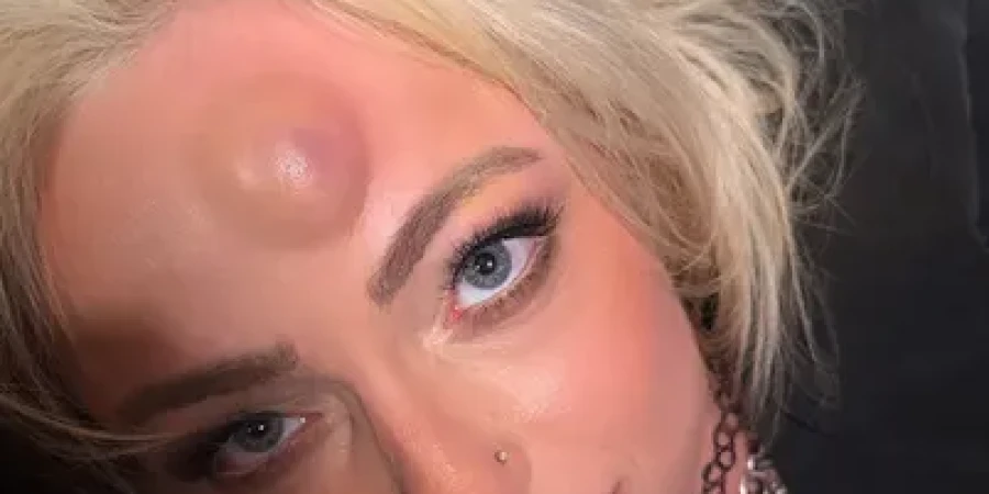 Звезда WWE показала жуткие последствия страшного удара