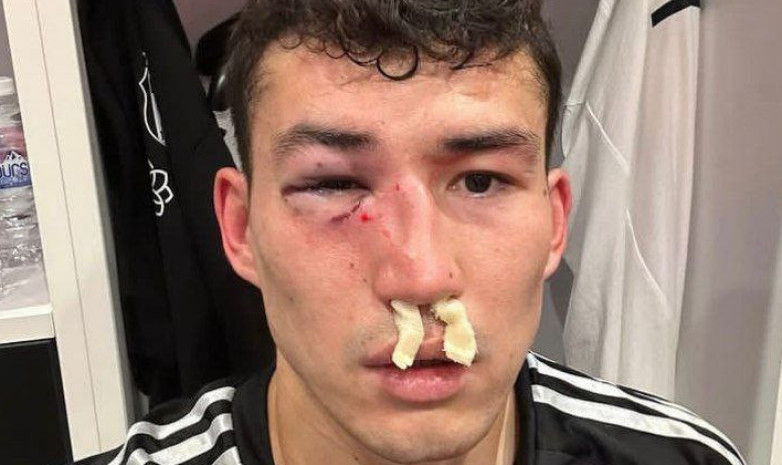Лучший футболист Казахстана был госпитализирован в больницу после удара локтем в матче турецкой Суперлиги