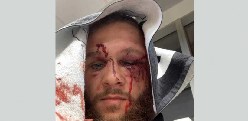 UFC: Рафаэль Физиев показал лицо после боя с Гэтжи. Фото
